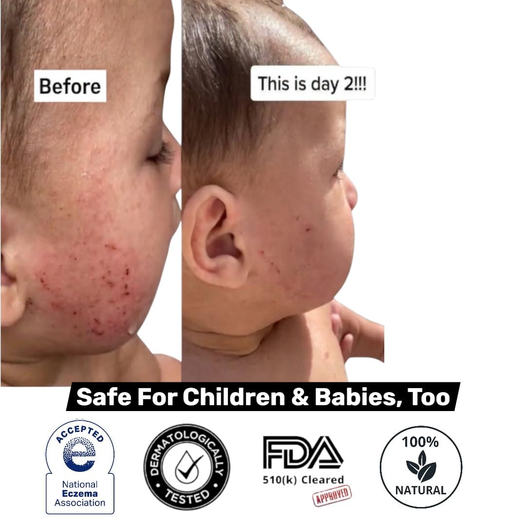 Loma Lux Eczemol NEA Seal label signals eczema safety recognition.