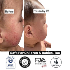 Loma Lux Eczemol NEA Seal label signals eczema safety recognition.
