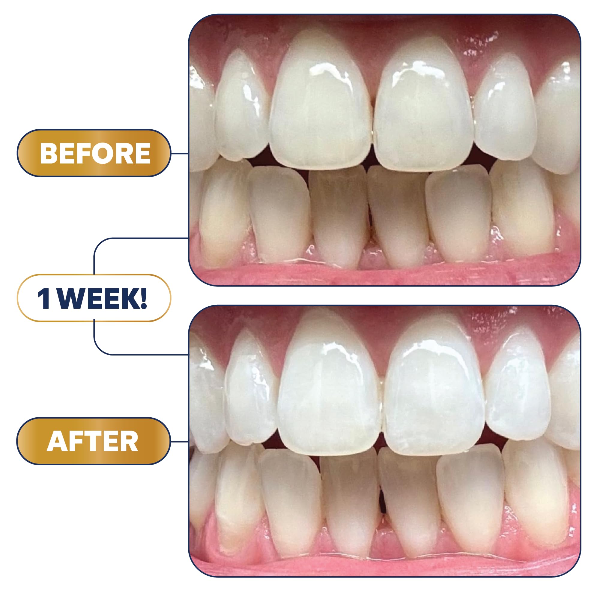 Lumineux Longevity bright smile result suggests a cleaner look and renewed confidence.