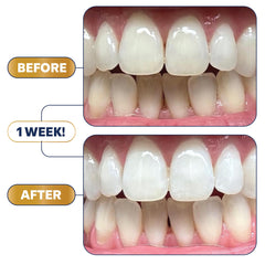 Lumineux Longevity bright smile result suggests a cleaner look and renewed confidence.