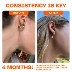Motivo Scar Care hypoallergenic design suited for sensitive skin.