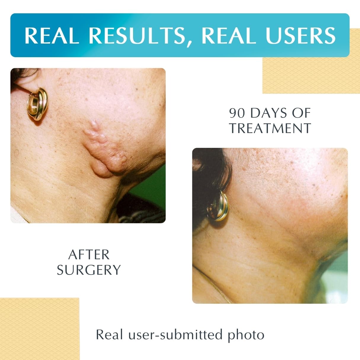 MyNewGel Advanced Scar Sheets on skin showing hydration
