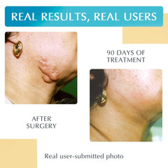 MyNewGel Advanced Scar Sheets on skin showing hydration
