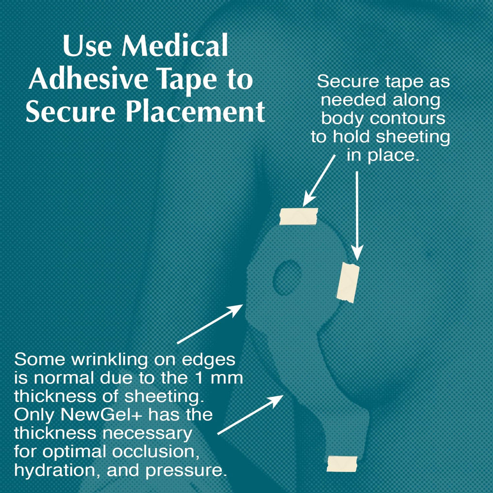 MyNewGel lollypop breast sheets support vertical scar management with gentle pressure.