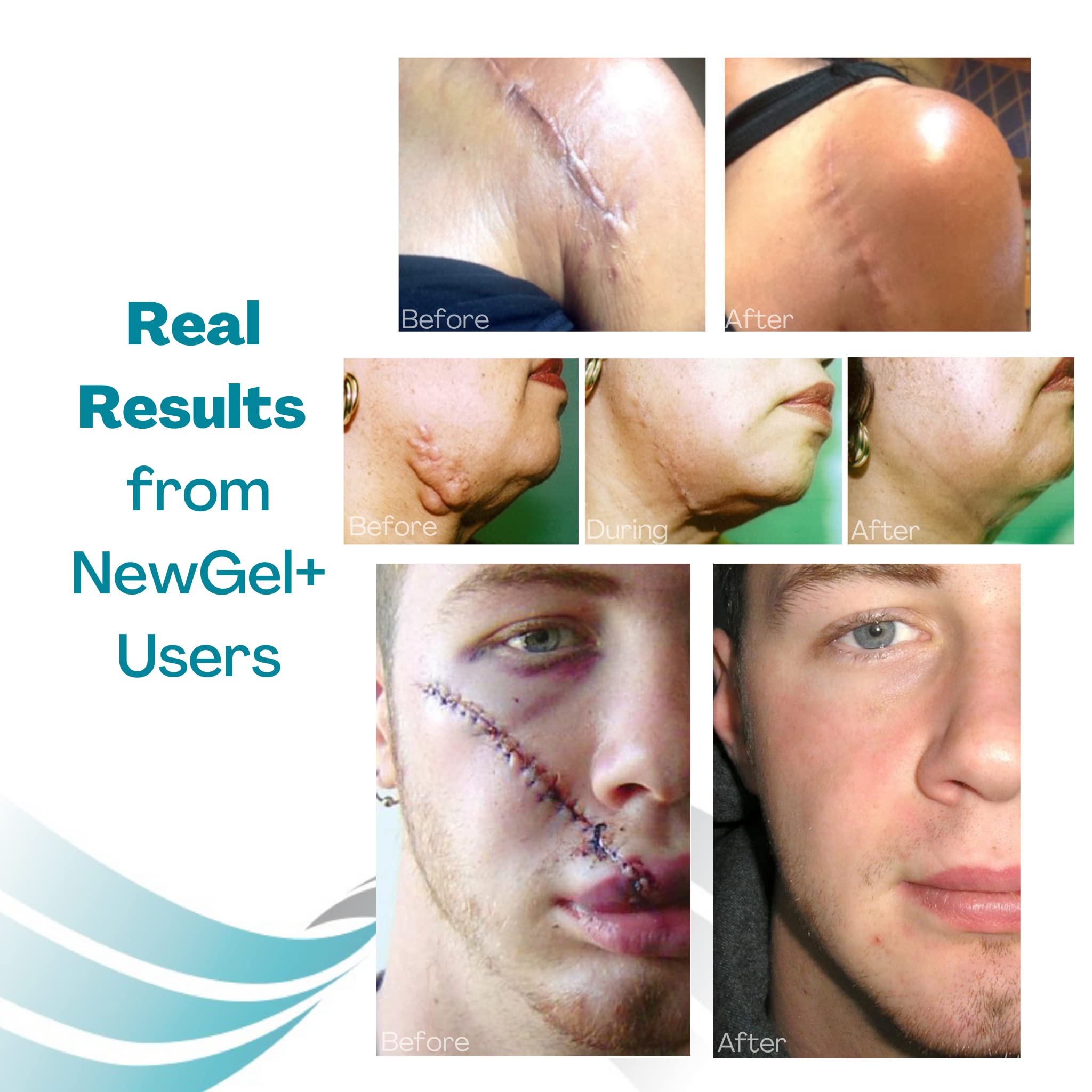 MyNewGel breast reconstruction scar kit in use on healing areas around the breast.
