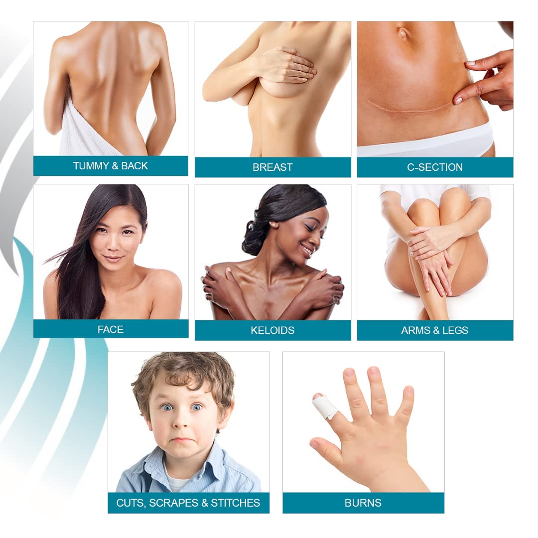 MyNewGel NewGel+ ideal for irregular scar areas post-surgery.