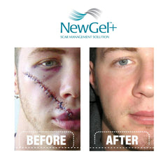 MyNewGel NewGel Plus Scar Gel helps with keloids appearance.