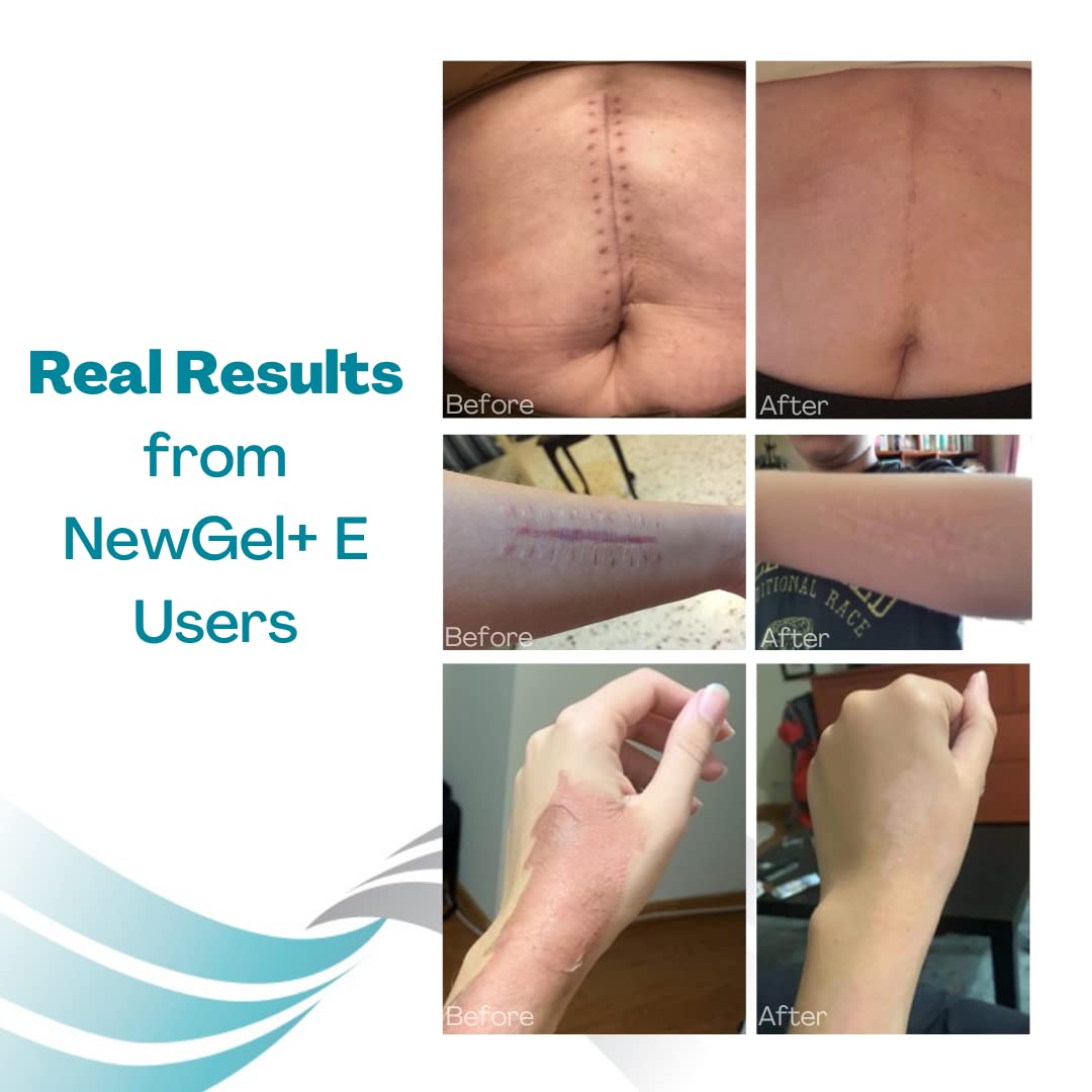 MyNewGel NewGel Plus Scar Gel suitable for post-surgery scars.