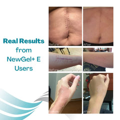 MyNewGel NewGel Plus Scar Gel suitable for post-surgery scars.
