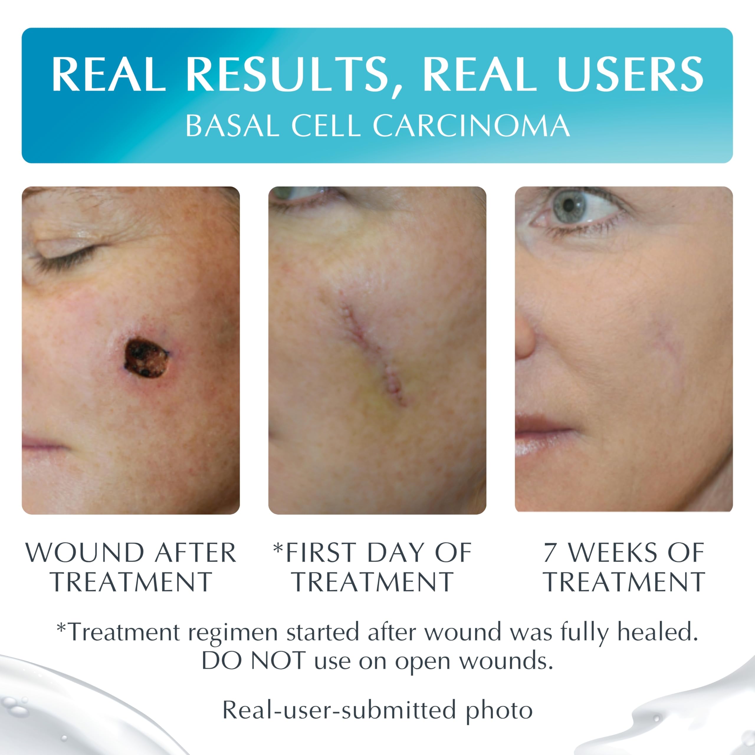MyNewGel NewGel Plus Scar Gel quick-dry texture on skin.