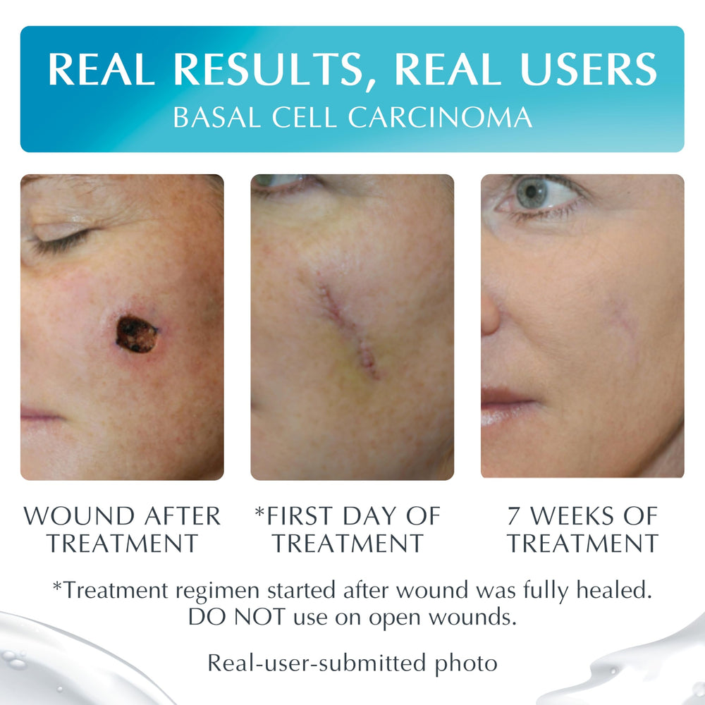 MyNewGel NewGel Plus Scar Gel quick-dry texture on skin.