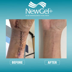 MyNewGel scar tape ultra-thick 2x24 beige patch for long-lasting wear.
