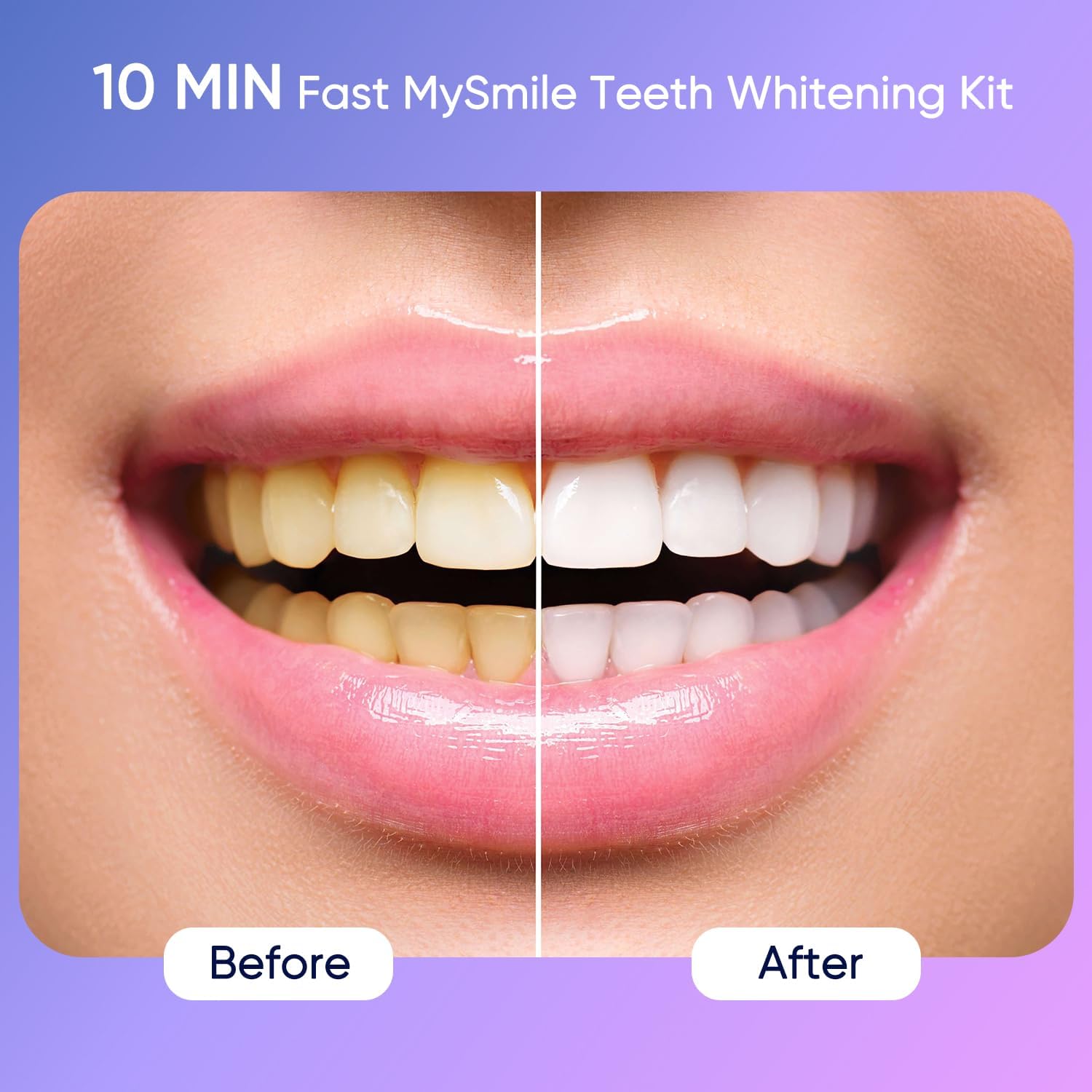 MySmile Deluxe LED light activated for faster whitening sessions.