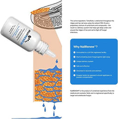 NailRENEW delivery system under nail bed, targets infection beneath the nail plate.