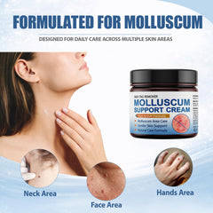 NateNatenight molluscum cream tube, easy 2–3 daily applications.