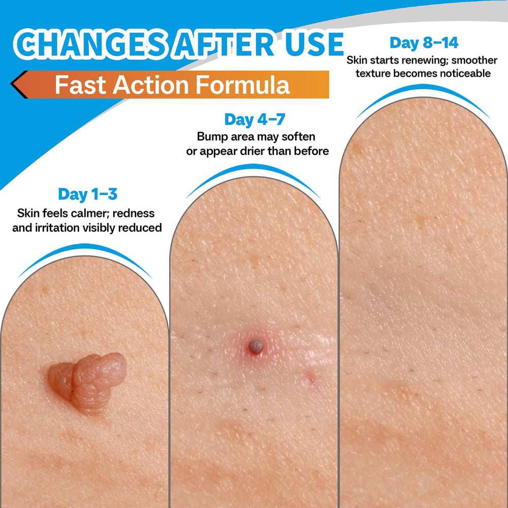 Applying NateNatenight Molluscum Support Cream to affected skin area.