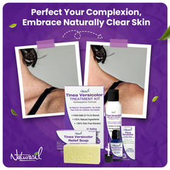 Naturasil Tinea Versicolor Kit packaging detail with label information.