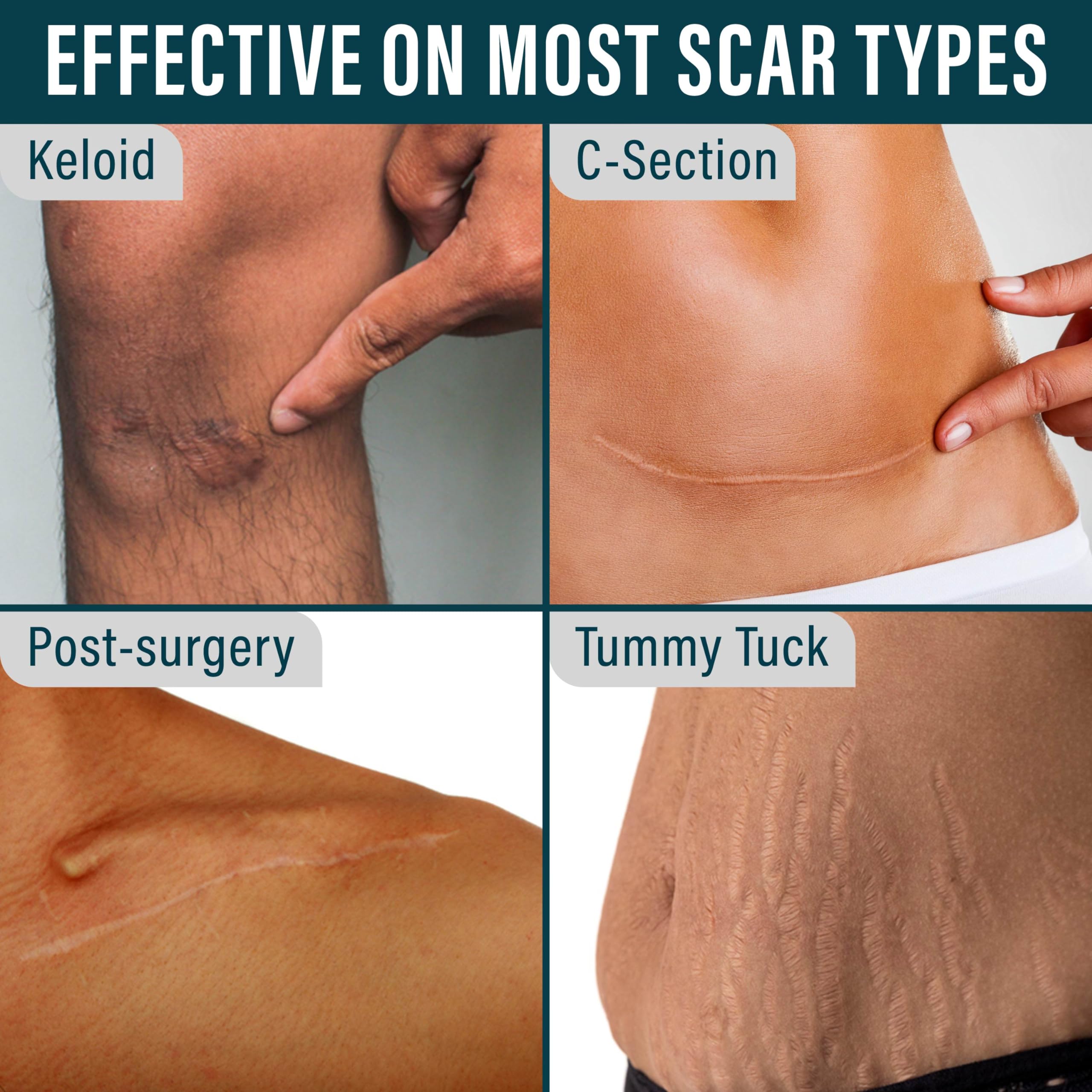 NUVADERMIS silicone tape cut-to-fit for precise scar coverage