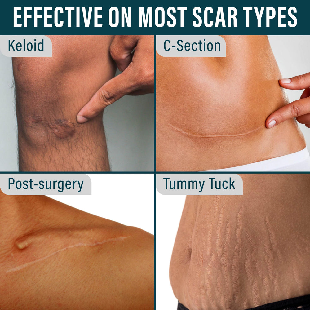NUVADERMIS silicone tape cut-to-fit for precise scar coverage