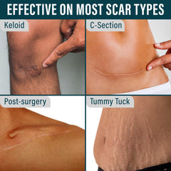 NUVADERMIS silicone tape cut-to-fit for precise scar coverage