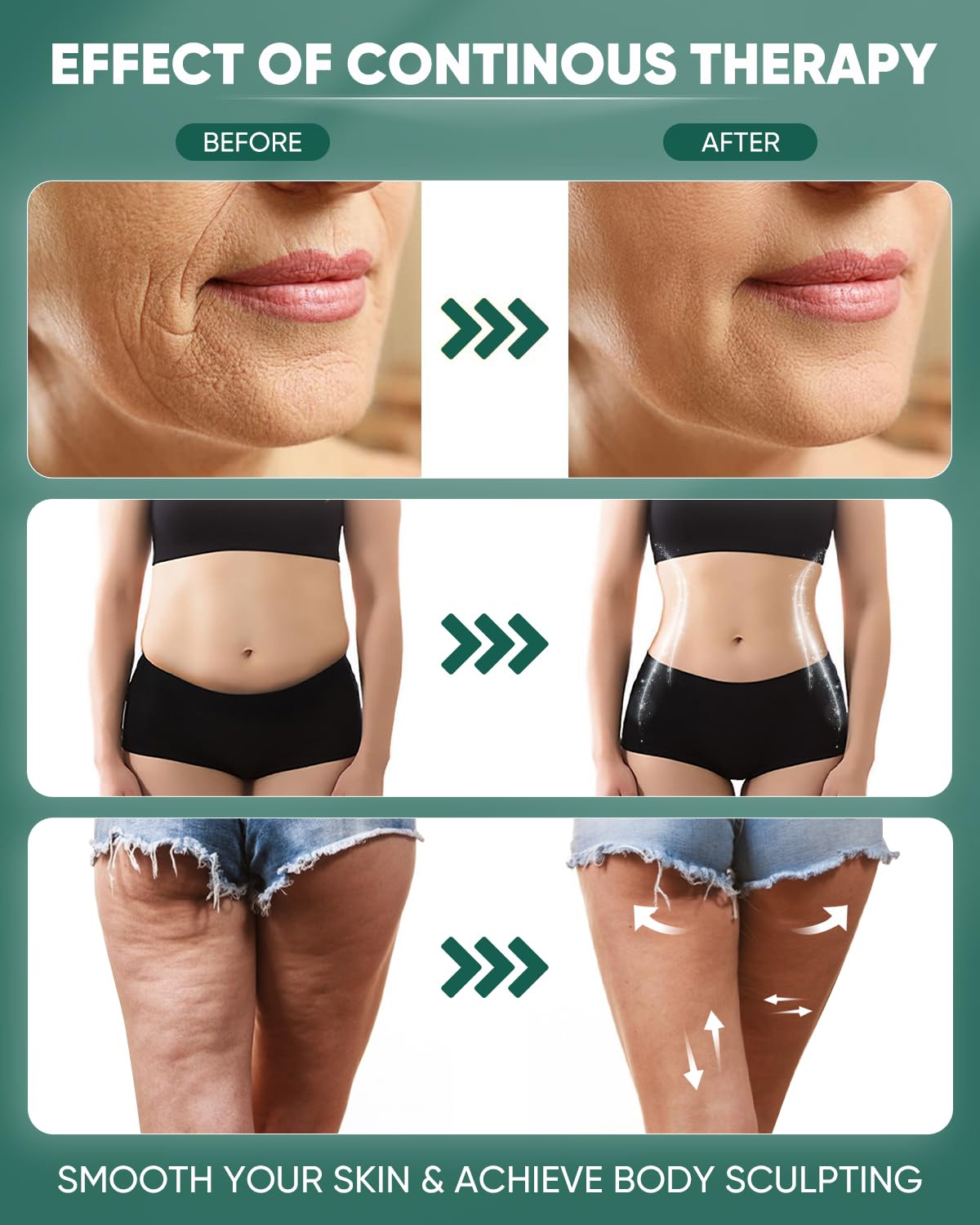 ONUEMP cellulite removal massage tool aids texture smoothing with regular use.