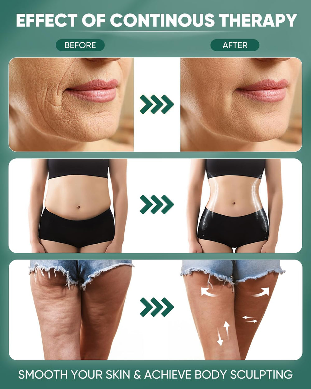 ONUEMP cellulite removal massage tool aids texture smoothing with regular use.