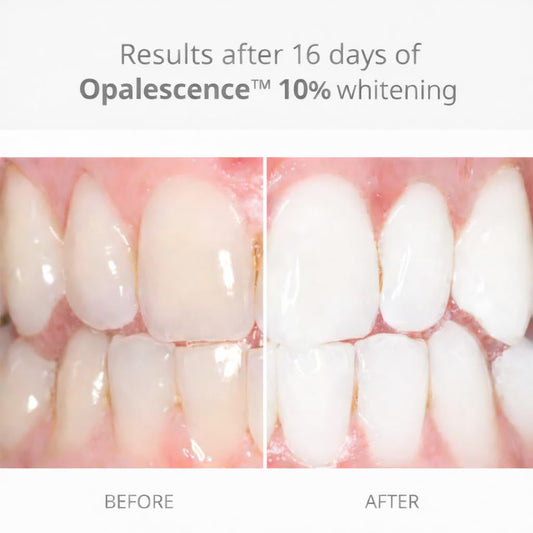 Opalescence melon-flavor gel close-up designed for comfortable whitening