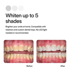 At-home whitening setup featuring Opalescence gel and trays.