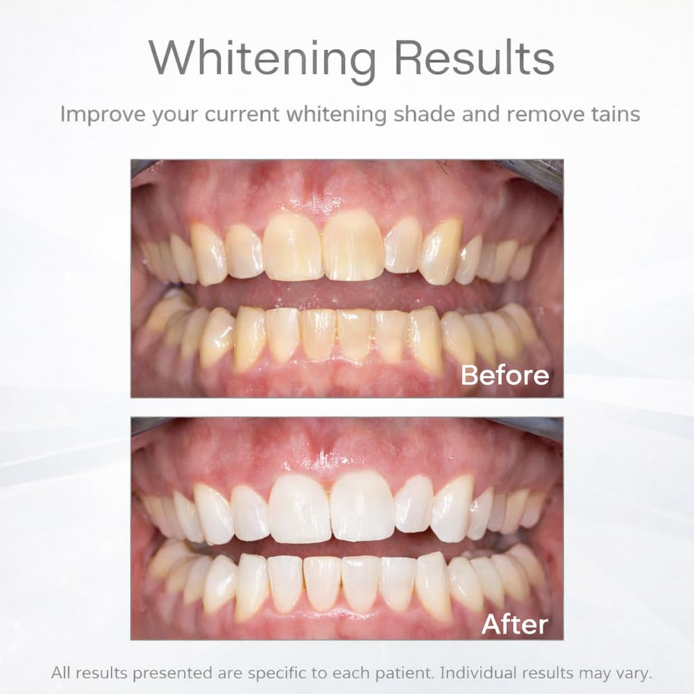 Opalescence Go mint gel inside trays for whitening at home