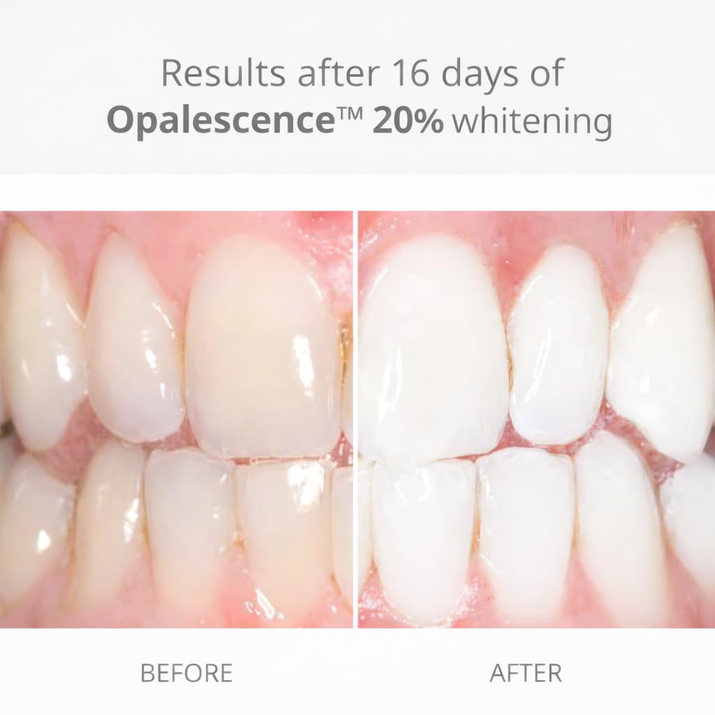 Opalescence Melon gel syringe demonstrates consistent bleaching with high-viscosity PF formula for custom trays.