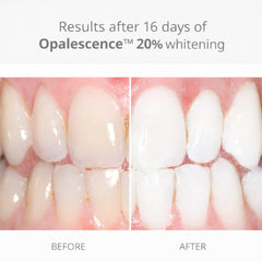 Opalescence Melon gel syringe demonstrates consistent bleaching with high-viscosity PF formula for custom trays.