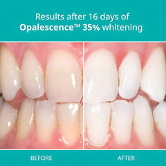 Opalescence PF 35% gel on whitening tray ready for 30–60 minute wear.