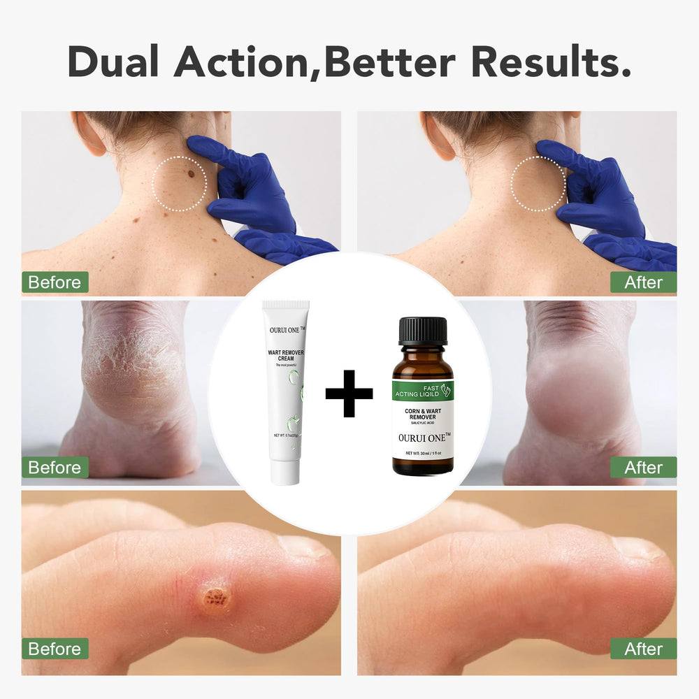 ourui one skin-tag ointment 2-step targets larger tags with gentle application