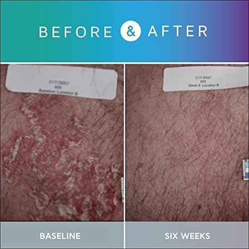 Prosoria treatment system day routine concept image.