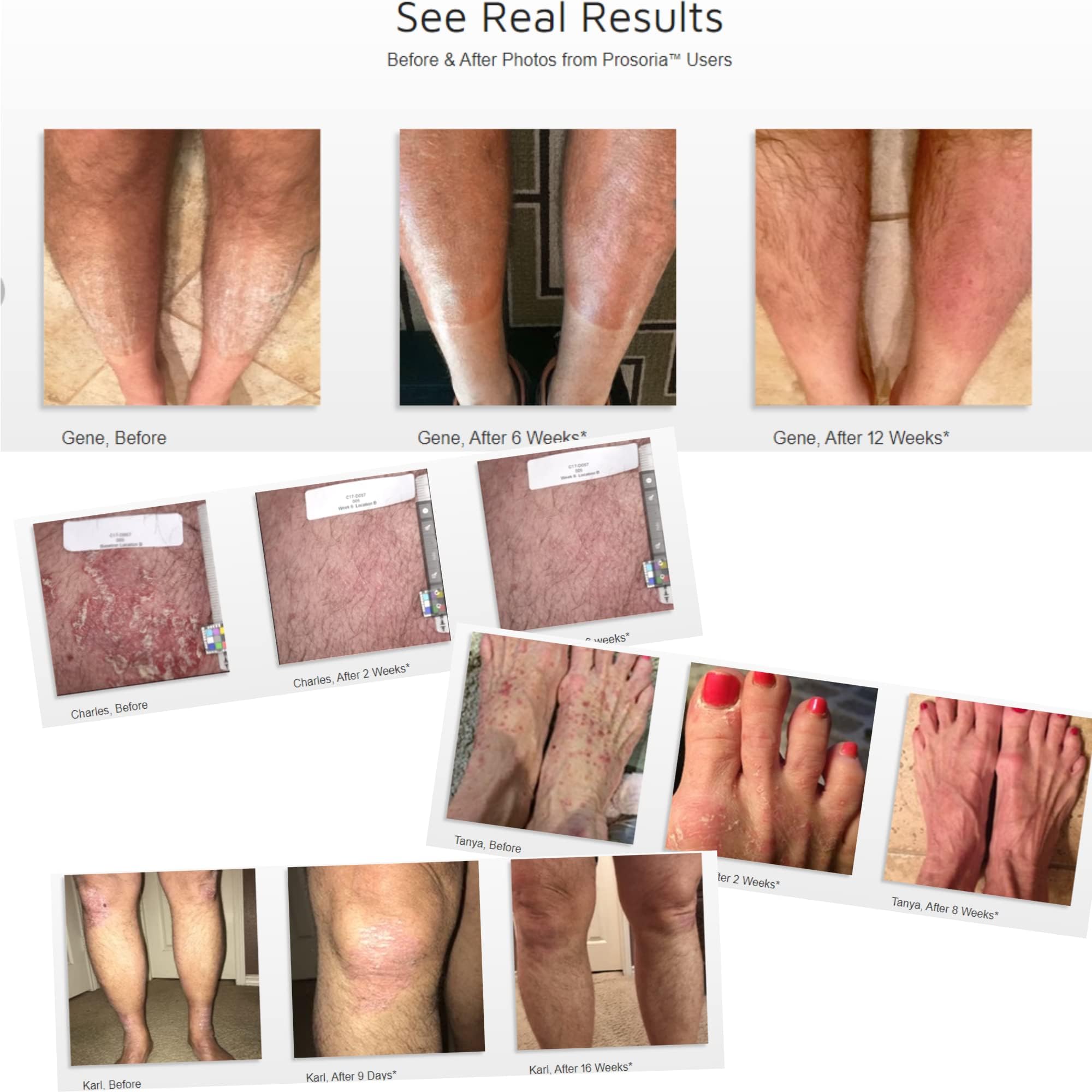 Prosoria treatment system natural ingredients label highlight botanicals.