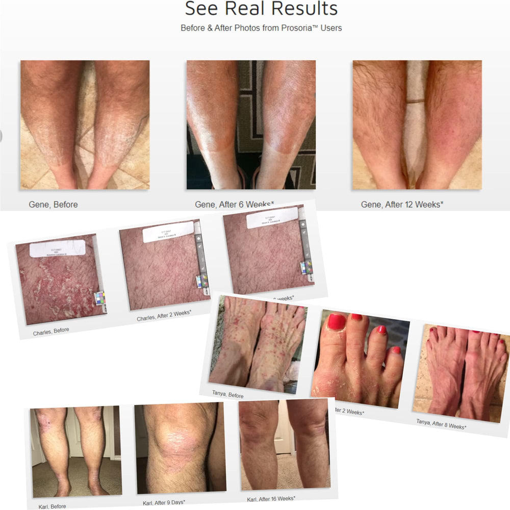 Prosoria treatment system natural ingredients label highlight botanicals.