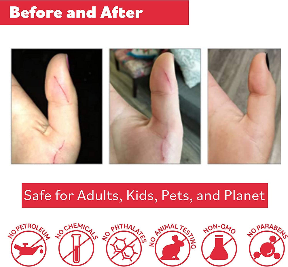 Close-up of Puremedy aiding skin care for burns and wounds.