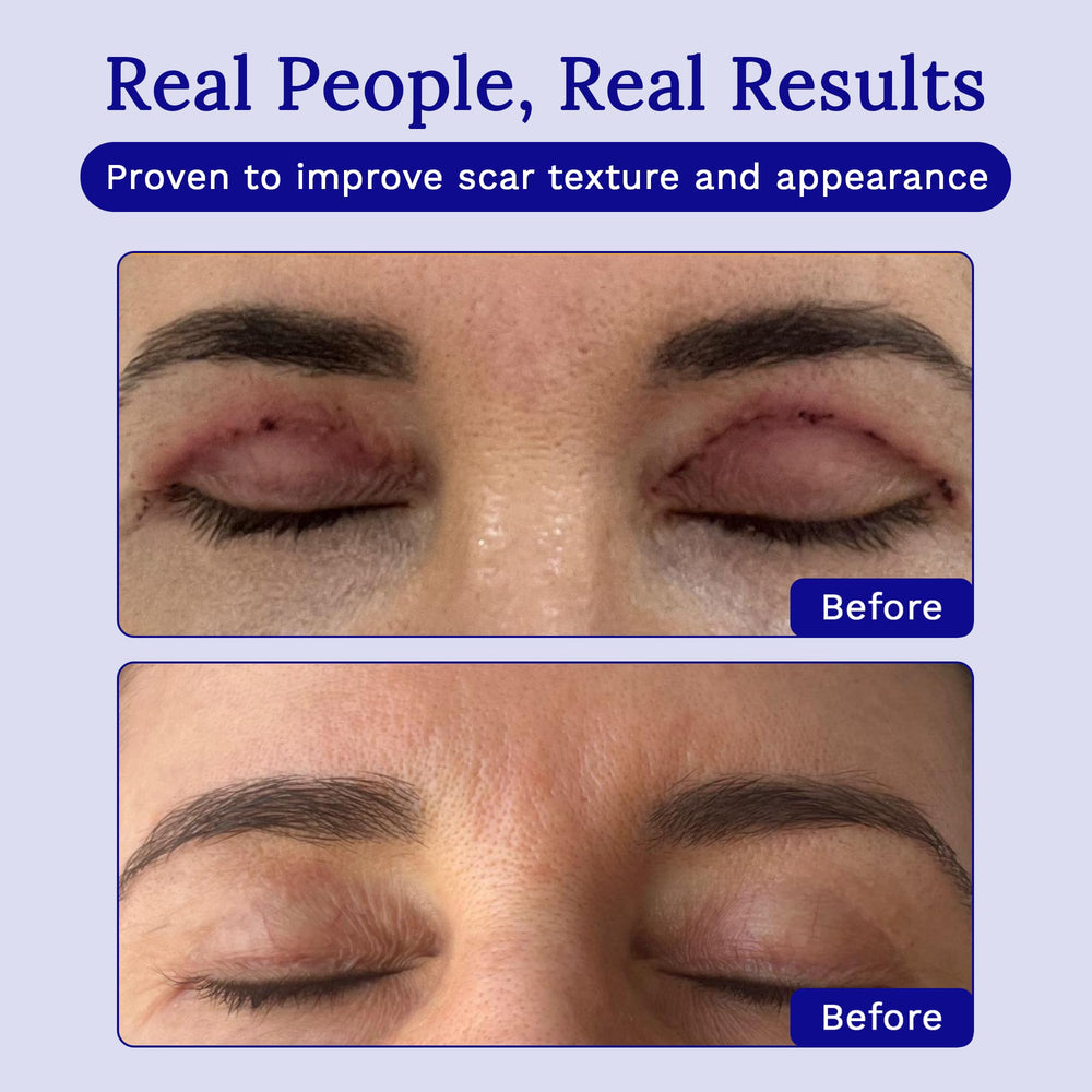 RejuvaSil with Vitamin C and silicone brightening scar tone.