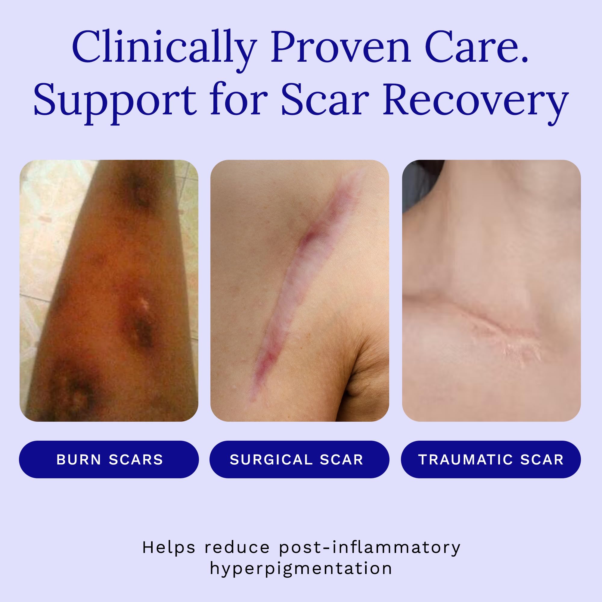 Rejuvaskin Scar Esthetique application massage demonstrates circular motion for pliability