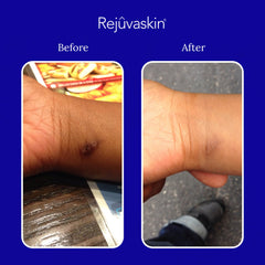 Adhesive silicone sheet from Rejuvaskin Scar Fx for scar management