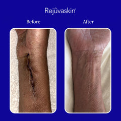 Close-up of Rejuvaskin silicone sheet in use on skin.
