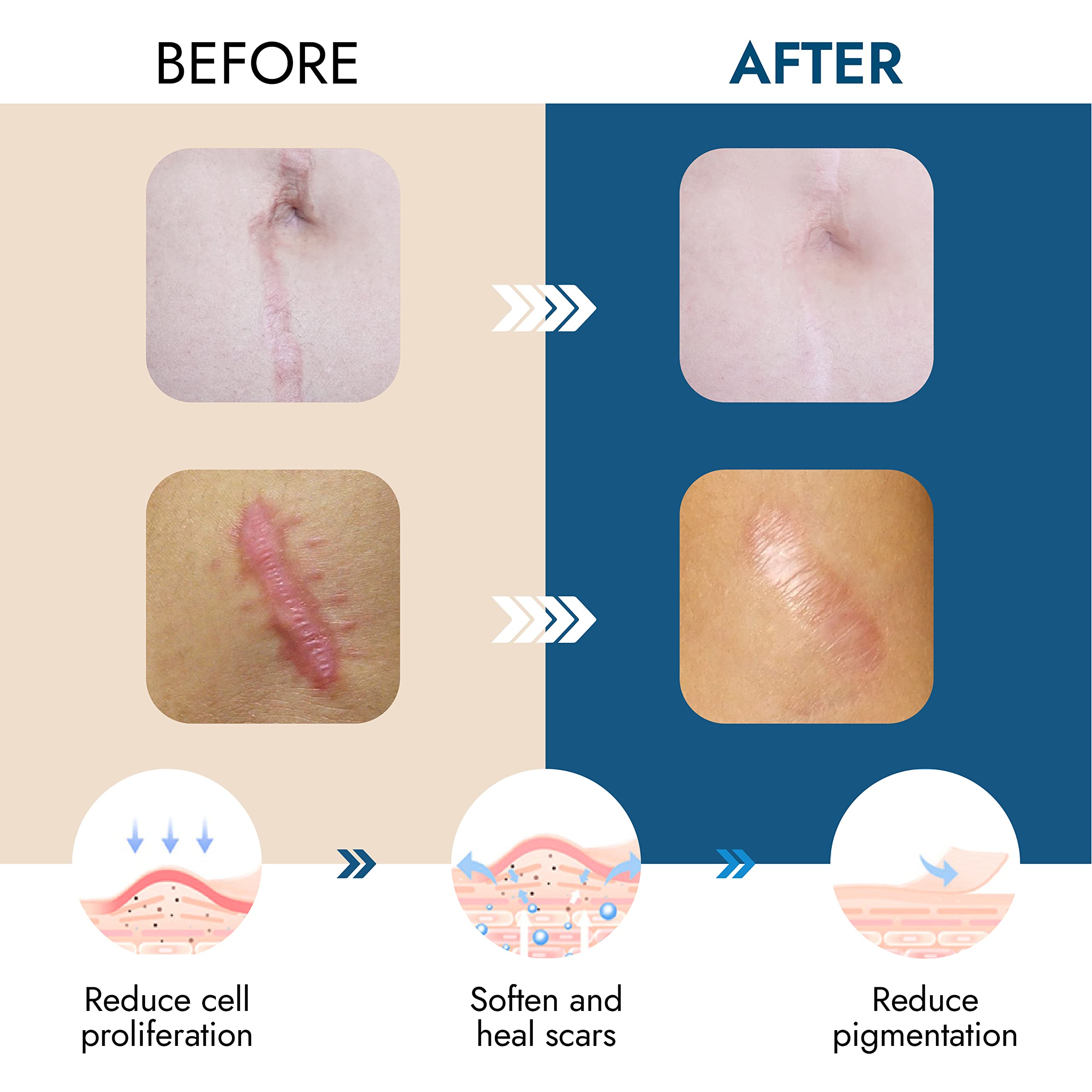 Scarbandit silicone tape applied on skin supports fading scars