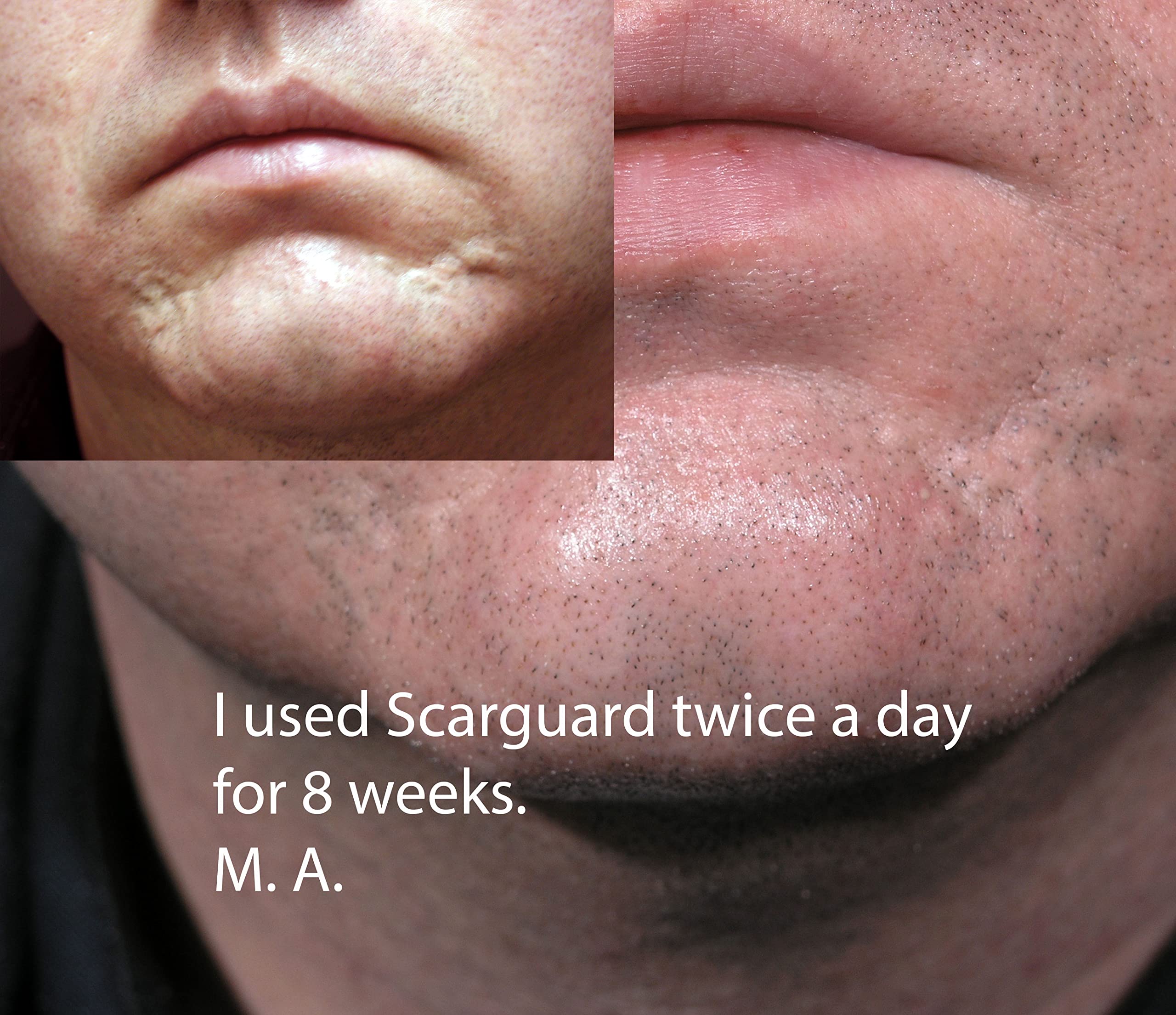 ScarGuard doctor-recommended silicone scar treatment in clinical-like setting.