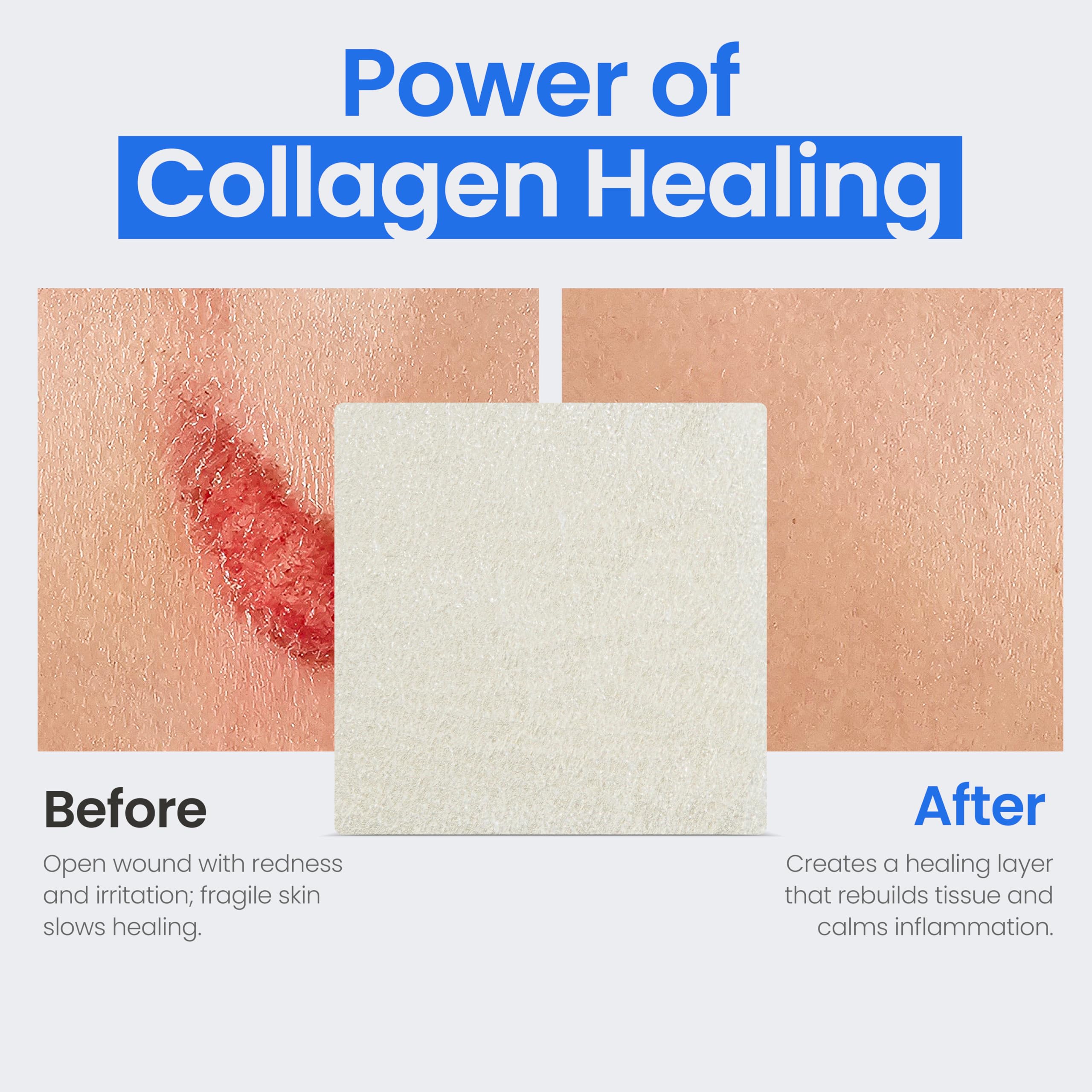 Simpurity collagen pads glutaraldehyde-free dressing offers careful wound support.