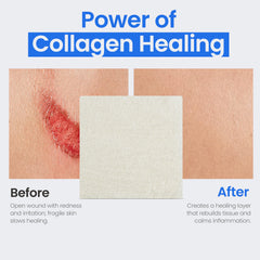 Simpurity collagen pads glutaraldehyde-free dressing offers careful wound support.