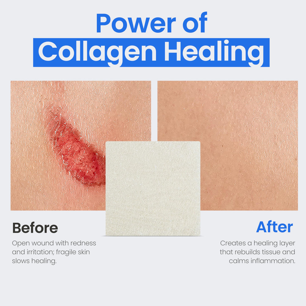 Simpurity collagen pads offer comfortable dressing changes for wound care.