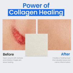 Simpurity collagen pads offer comfortable dressing changes for wound care.