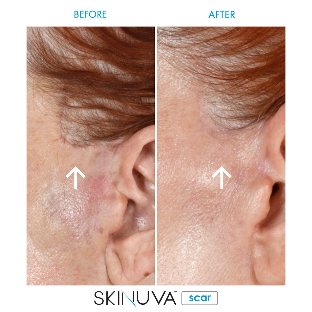 Skinuva clinical study graphic indicates evidence-based scar improvement discussion
