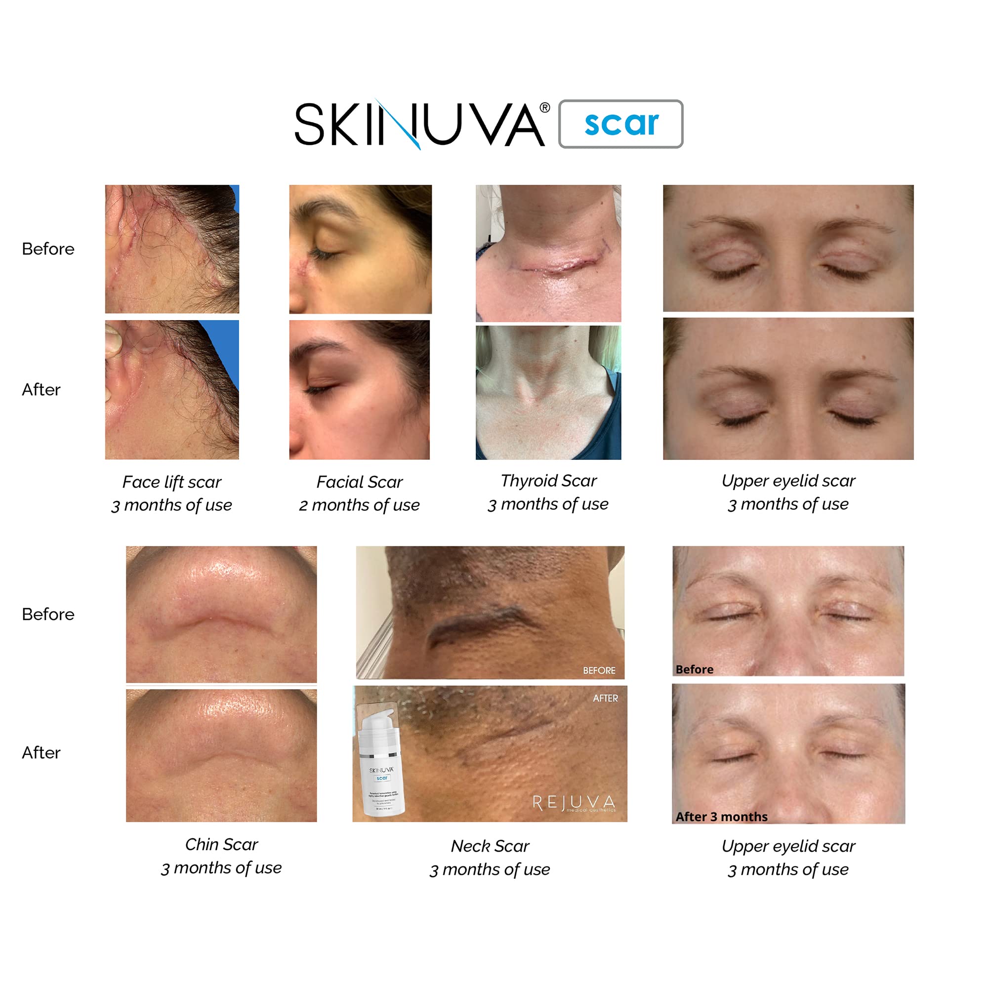 Skinuva packaging box close-up signals physician-developed scar therapy.