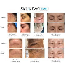 Skinuva packaging box close-up signals physician-developed scar therapy.